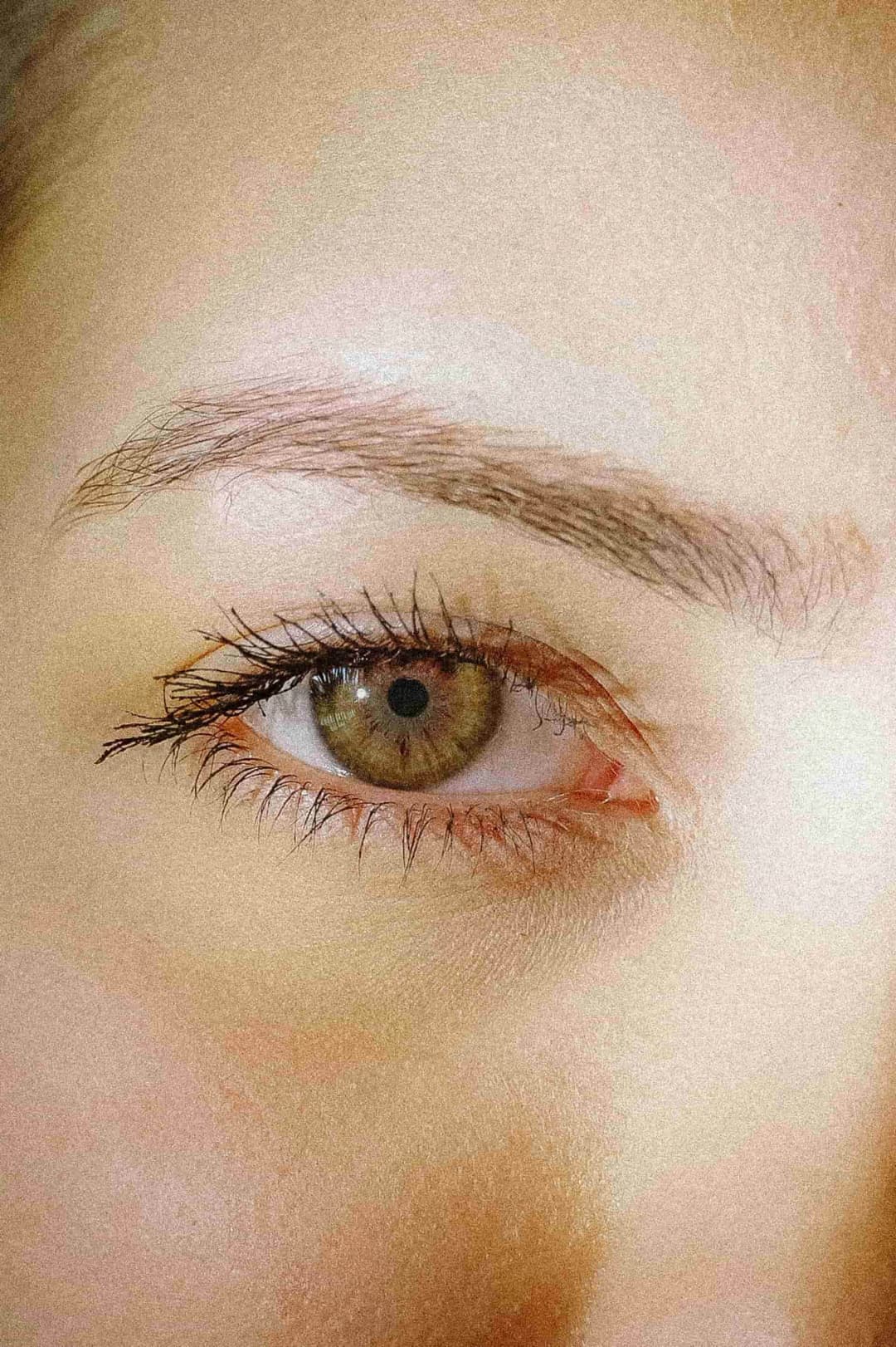 Eyelid Surgery procedure illustration