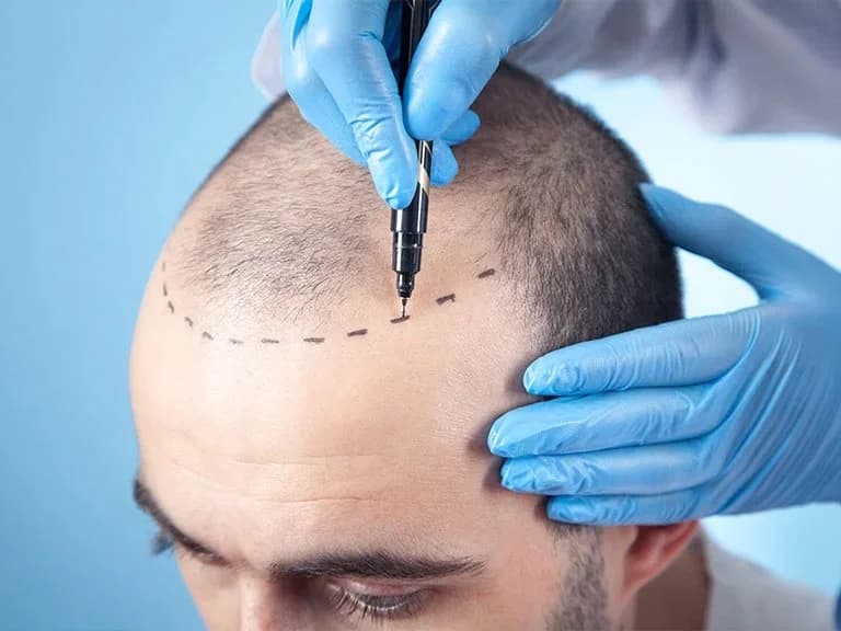 Hair Transplant procedure illustration